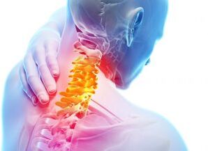 Fájdalom és menedékek a nyaki övezetben az osteochondrosis harmadik fokával