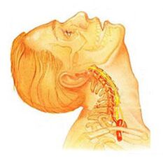 A nyaki gerinc osteochondrosis
