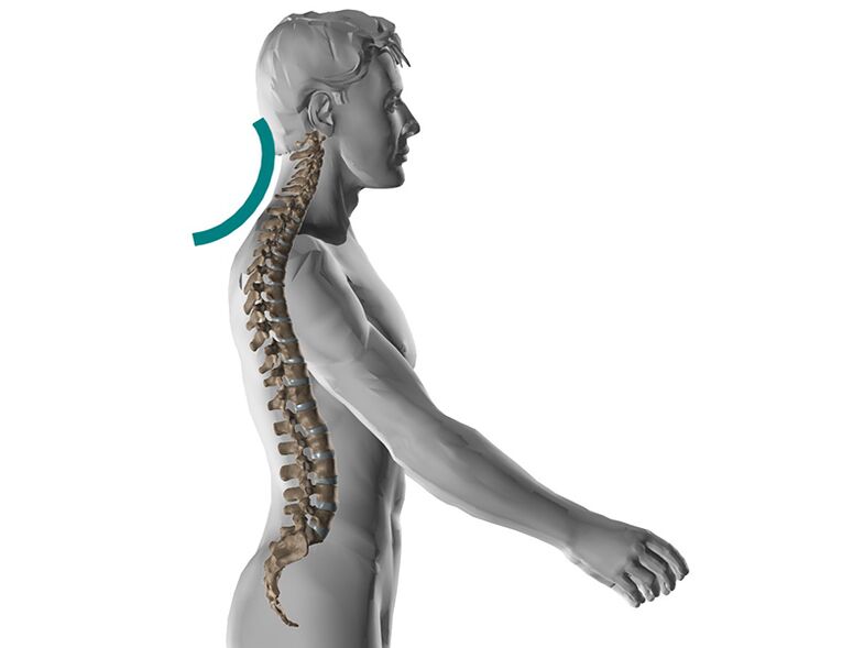 A gerinc nyaki osteochondrosisa, sok kellemetlen tünetet okozva